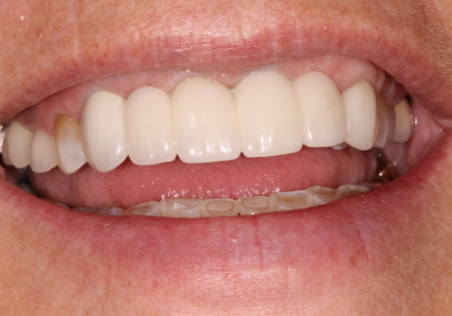 IMG_1467 Patient Image #4