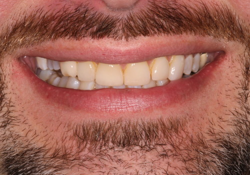 Veneer-B-1 Before #1