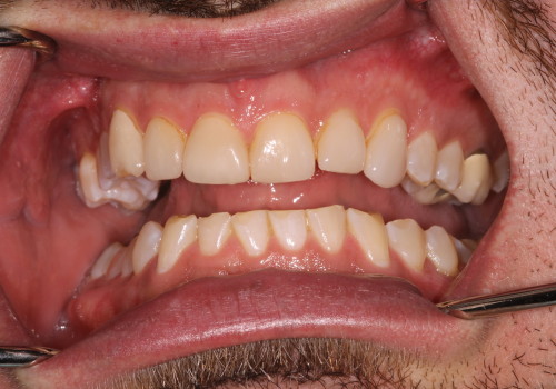 Veneer-B-2 before