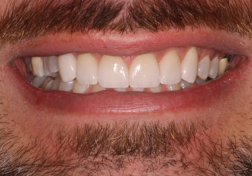 Veneer-B-3 After