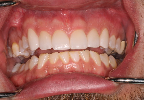 Veneer-B-4 after